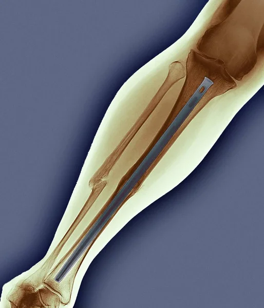 Зламана нога, кольоровий рентгенівський знімок . — стокове фото
