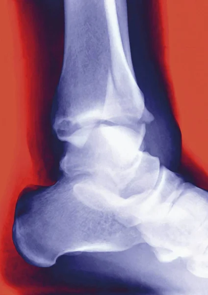Radiografía que muestra una tibia fracturada - foto de stock
