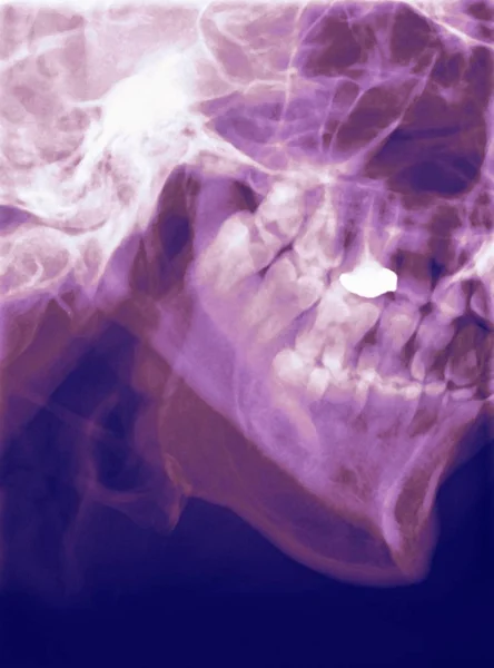 Цветной профиль рентгеновского снимка челюсти человека (нижняя челюсть ). — стоковое фото