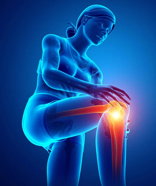 Mujer Knee dolor articular — Foto de Stock