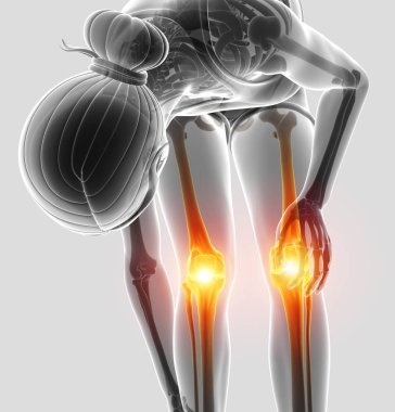 Diz ağrısı hissediyor kadın 3D çizim