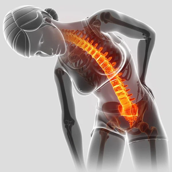 3D Illustration of Female Feeling the back pain — Stock Photo, Image