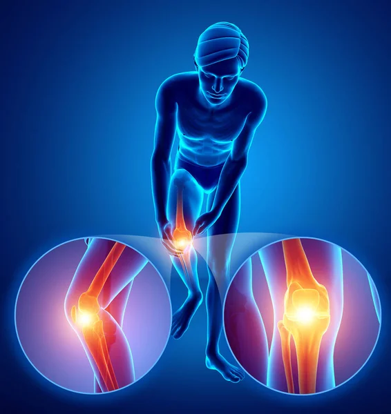 3D ilustracja z męskiej uczucie bólu kolana — Zdjęcie stockowe