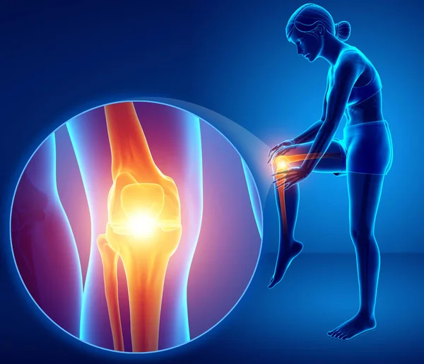 Ilustración 3d de sensación femenina Dolor de rodilla — Foto de Stock