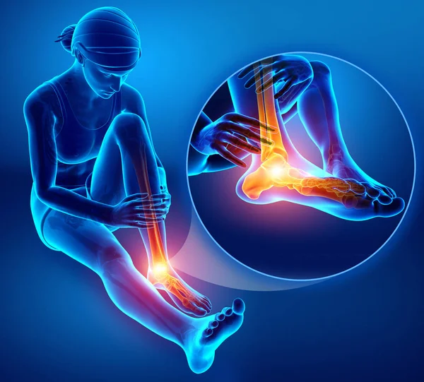 3D obrázek ženské nohy s bolestí kotníku — Stock fotografie