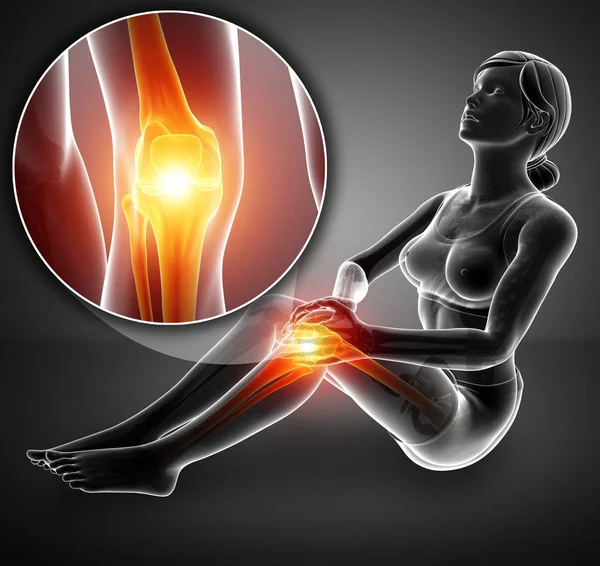3D απεικόνιση του γυναικείου αισθάνεται πόνο στο γόνατο — Φωτογραφία Αρχείου