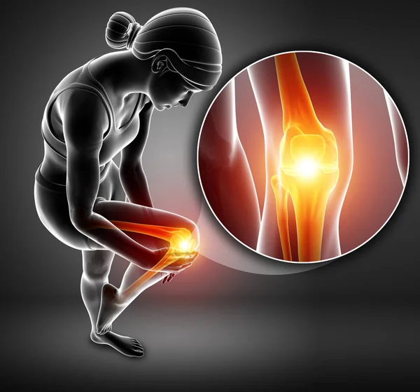 3d Illustration of Female feeling Knee pain — Stock Photo, Image