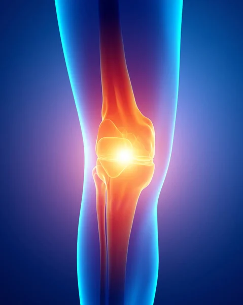 膝の痛みを感じる男性の 3 d 図 — ストック写真