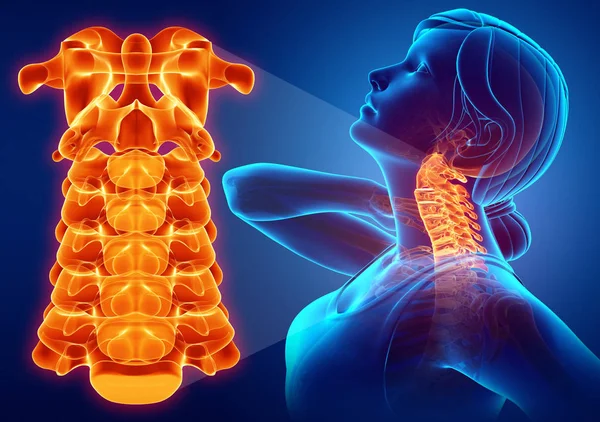 3D Illustration des weiblichen Gefühls der Nackenschmerzen Stockbild