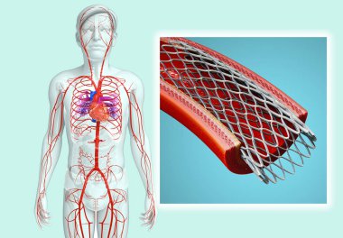 Erkek atardamar sistemi genişletilmiş stent için 3D resimleme