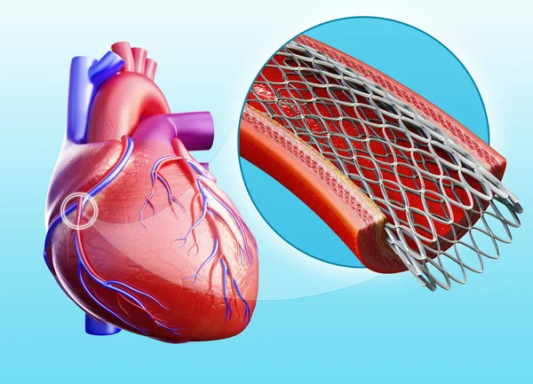 3d rendered illustration of expanded stent — Stock Photo, Image