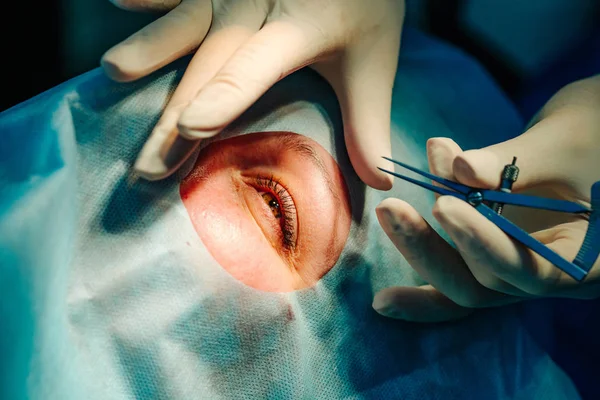 Korrigering av laserseende. En patient och en kirurg i operationssalen under ögonkirurgi. Stängt öga. Patienten under sterilt skydd. Närbild — Stockfoto