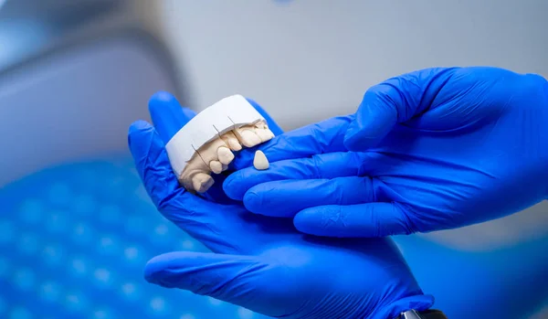 Dentystyczny, stomatologiczny proteza polerowanie. Sztuczny ząb, proteza — Zdjęcie stockowe