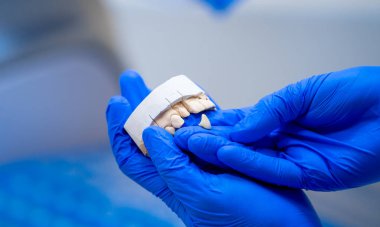 İmplant model diş destek ünitesini kapatın köprü implantı ve taç takın. Dişçi çenesi. Doktorun elinde diş modelliği öğretiyor. Takma diş. Yakın çekim..