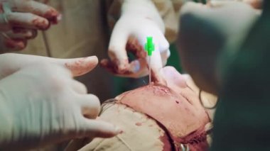 Ameliyatta. Cerrahlar, hastanedeki ameliyathanede eldivenli bir hastanın yüzüne ameliyat yaparlar. Yakın plan.