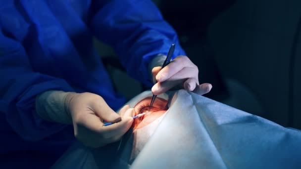 Operacja Chirurgiczna Chirurg Operujący Zaćmę Oka Chirurgii Szpitalnej Operacja Okulistyczna — Wideo stockowe