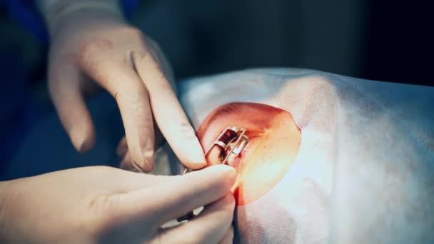 Dokter Voert Een Operatie Uit Close Shot Van Vrouw Met — Stockvideo