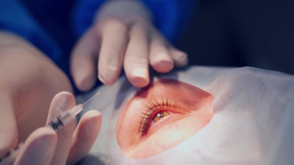 Paziente Sotto Copertura Sterile Dettaglio Ravvicinato Della Chirurgia Dell Occhio — Video Stock