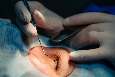 Oftalmoloji operasyonu. Eldivenli cerrahın elleri lazer görme düzeltmesi yapıyor.