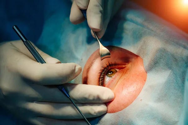 Laserkorrigering För Sikt Oftalmologisk Operation För Ögon Synkorrigering — Stockfoto