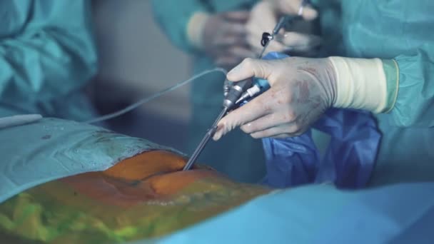 Process Surgery Operation Medical Team Performing Surgical Operation Bright Modern — Stock Video