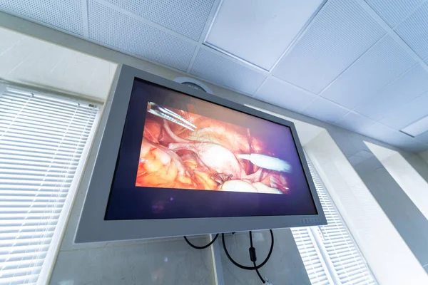 Process of surgery operation using laparoscopic equipment. Operating room with surgery equipment. Medical background. Monitoring the process on screen.