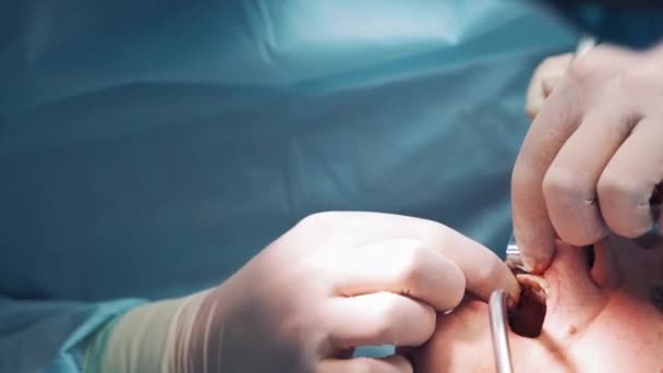 牙科医生的手在诊所把金属针插入病人的嘴 口腔科医生和一名护士在医院做牙科手术 口腔手术 — 图库视频影像