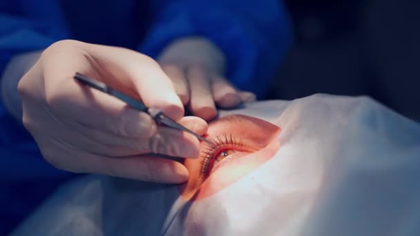 Ojo Abierto Paciente Durante Operación Manos Cerca Guantes Médico Profesional — Vídeo de stock