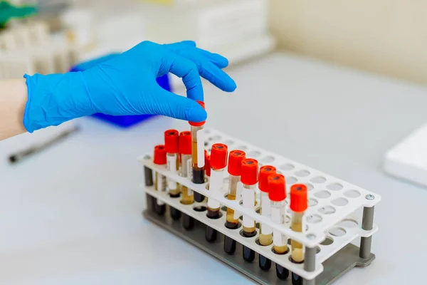 Nurse Hand Arranges Test Tubes Blood Tray Virus Infection Pneumonia — Stock Photo, Image