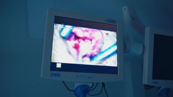 모니터에 수술을 운영중인 현대의 병원에 장비의 스크린에 — 비디오