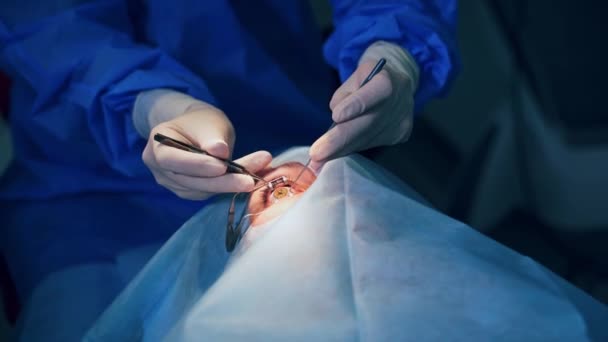 Operación Oftalmológica Manos Cirujano Con Guantes Realizando Corrección Visión Ocular — Vídeo de stock