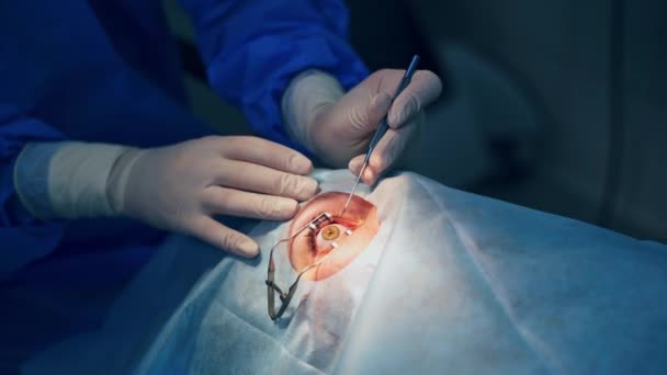 Operacja Korekty Wzroku Ręce Chirurga Rękawiczkach Wykonujących Operację Okulistyczną Nowoczesna — Wideo stockowe