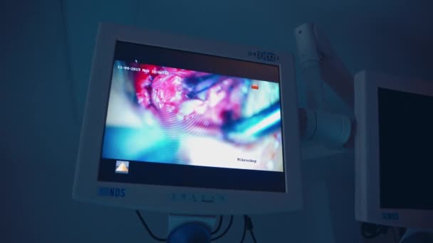 Proces Van Endoscopische Chirurgie Het Scherm Chirurgie Demonstrerend Een Display — Stockvideo