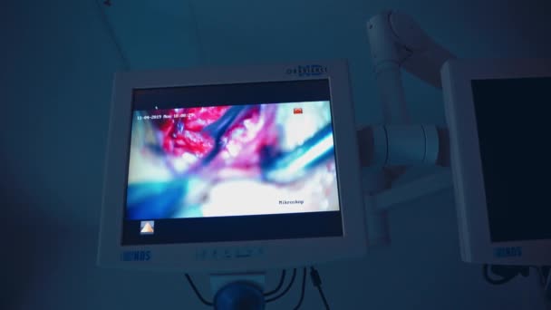 Сюрпризы Мониторе Нейросургический Процесс Отображается Экране Современное Оборудование Операционной Концепция — стоковое видео