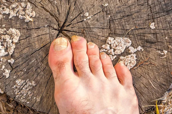 Ноги мужчины инфицированы грибком ногтя . — стоковое фото