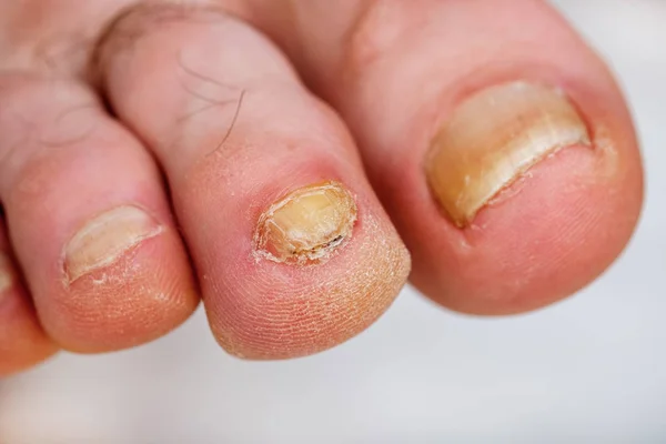 Deformed nail plate of the toe, infected with a nail fungus.