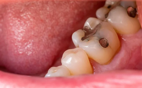 Altında Metal Dolgu Olan Alt İki Azıdişi