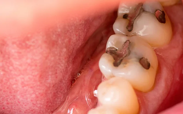 Altında Metal Dolgu Olan Alt İki Azıdişi