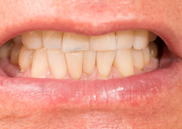 Dişçiye göstermek için ön ve alt dişleri ısıran adam.