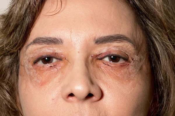 Mujer Que Sometió Cirugía Lifting Ocular Ambos Ojos — Foto de Stock