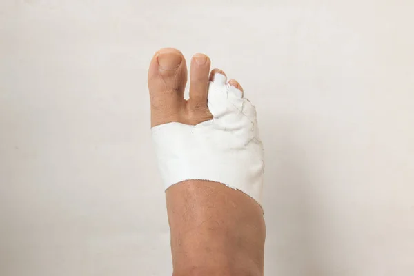 Close Man Bandaged Broken Toe — Stock Photo, Image