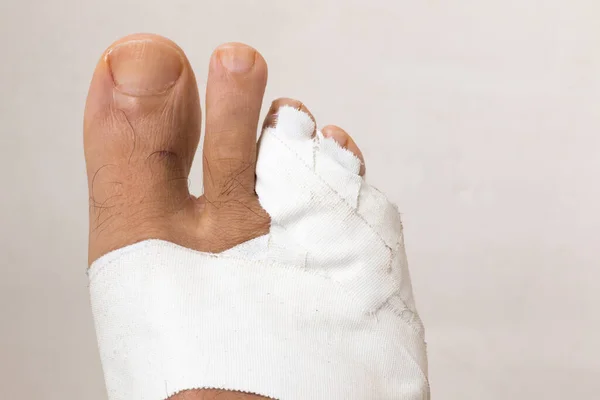 Close Man Bandaged Broken Toe — Stock Photo, Image