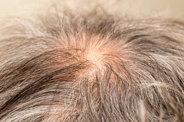 Older man with thinning hair on the back of his head around the crown