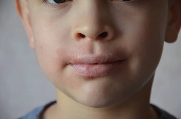 Fermer les lèvres et le visage d'un écolier ou d'un adolescent allergique. Irritation des lèvres. Portrait d'enfant souriant éternuant, nez égratigné, allergie saisonnière, maladie moderne — Photo