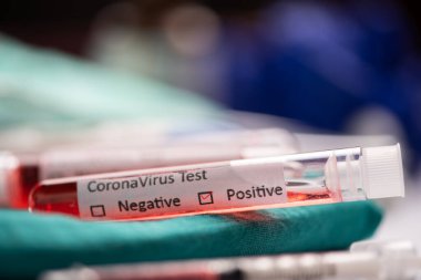 2019-Ncov. Coronavirus laboratuvarında Coronavirus kan testi