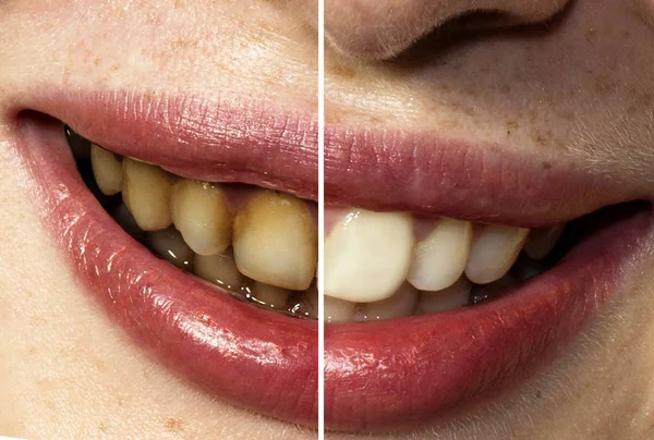 Before and after cleaning the teeth of mouth smiling girl