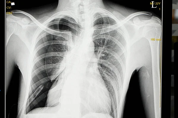 Spontán pneumothorax — Stock Fotó