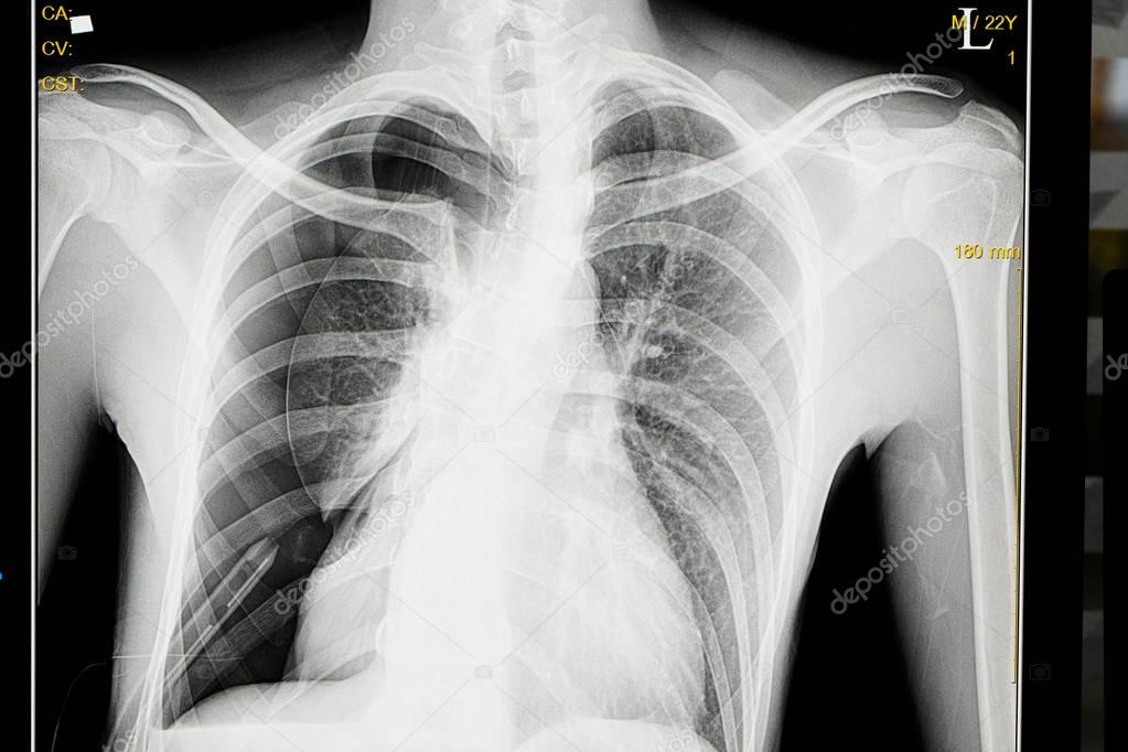 Spontaneous pneumothorax