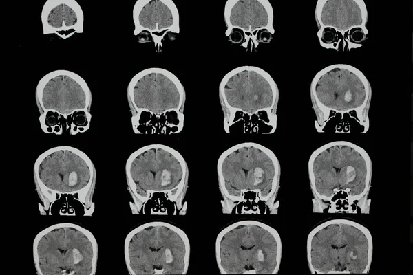 Tomografia Computadorizada Cerebral Paciente Com Grande Hemorragia Intracraniana Acidente Vascular — Fotografia de Stock