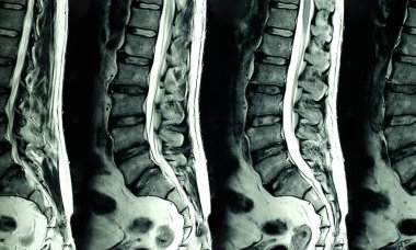 L4-5 disk ve L4 sinir kökü kompresyonu sağ lateral çıkıntı ile L dikenlerin dejeneratif değişim gösteren kronik sırt ağrısı olan bir hastanın lomber dikenlerin MRi taraması